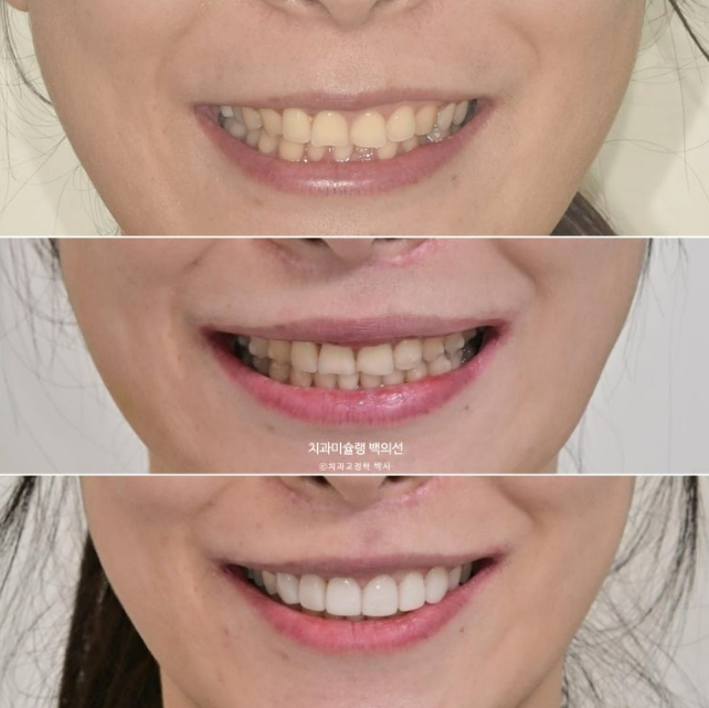 비발치 덧니 교정 인비절라인 과개교합 교정 무삭제 라미네이트 치료 후기 관련 이미지 1