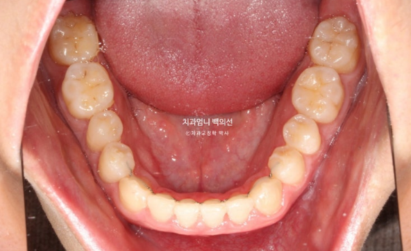 MSE Palatal Expansion Invisalign Underbite Correction, Non-Surgical image 17