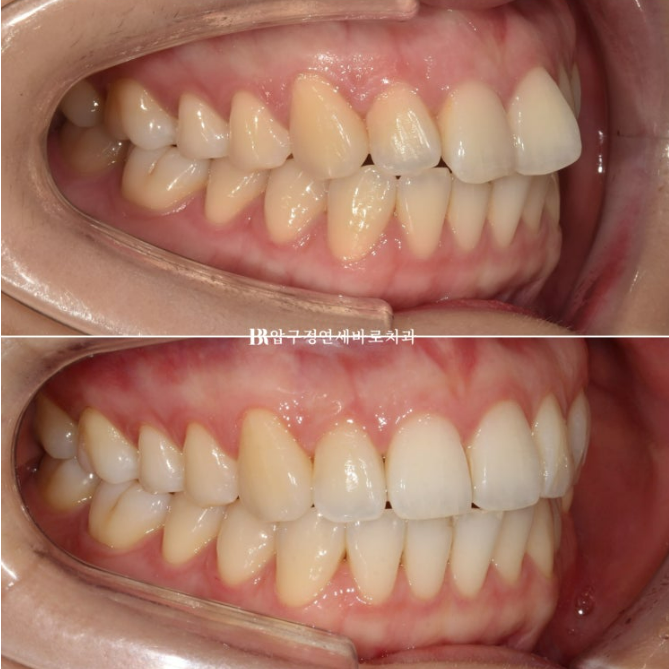 Can Rabbit Teeth Be Corrected? 5-Month Real Case of Butterfly Teeth Anterior Partial Orthodontic Treatment image 9