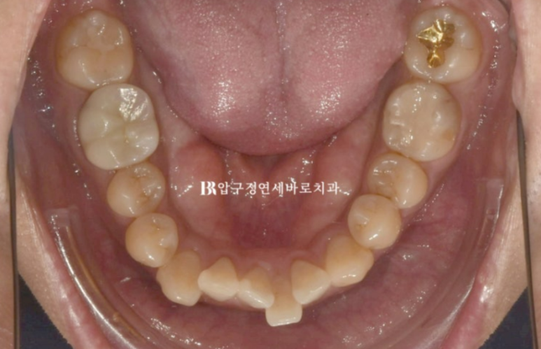 40대 중년 치아교정 인비절라인 라이트 치료기간 8개월 관련 이미지 5