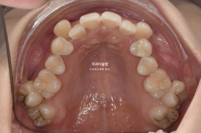 인비절라인 비발치 제2대구치 발치 사랑니 대체 교정 심한 덧니 교정 치료 관련 이미지 5