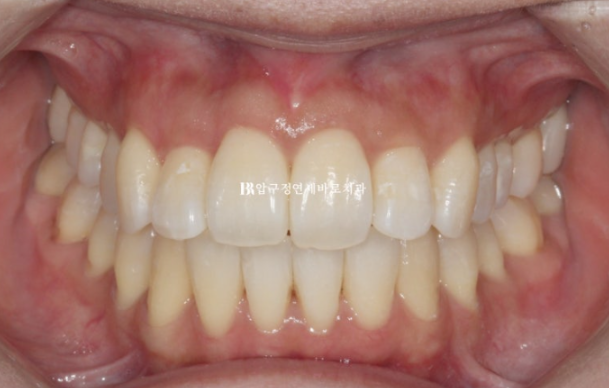 예비신부 교정 단기 앞니 부분교정 치료기간 6개월 관련 이미지 11