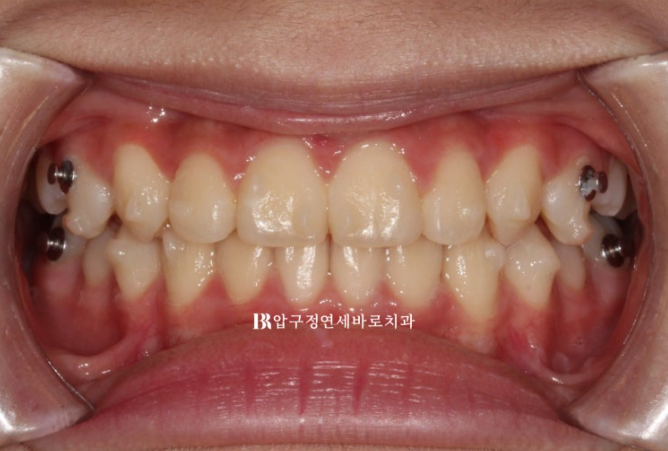 어린이교정 투명교정 인비절라인 퍼스트 후기 관련 이미지 8