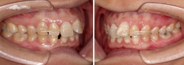 30대 교정 돌출입 교정 덧니 발치교정 치료기간 1년 8개월 관련 이미지 5