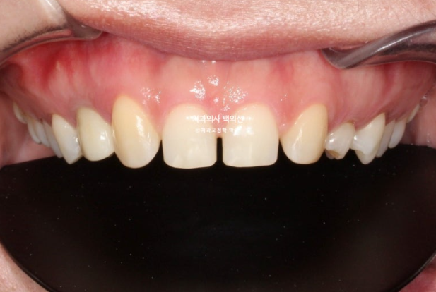 앞니 선천적 결손 벌어짐 잔존 유치 무삭제 라미네이트 관련 이미지 6