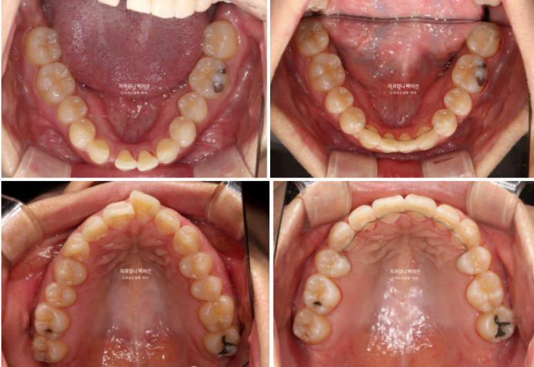 30대 교정 돌출입 교정 덧니 발치교정 치료기간 1년 8개월 관련 이미지 11