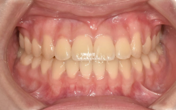 비발치 비수술 주걱턱 반대교합 재교정 치료 관련 이미지 9
