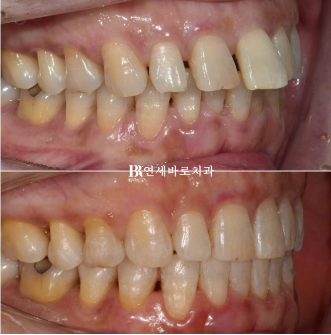 50대 치아벌어짐 단기 교정 가능할까요? 관련 이미지 4