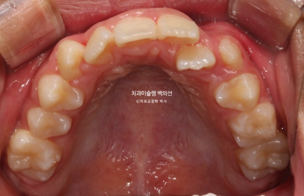 덧니 반대교합 과개교합 인비절라인 퍼스트 악궁확장 어린이 교정 관련 이미지 4