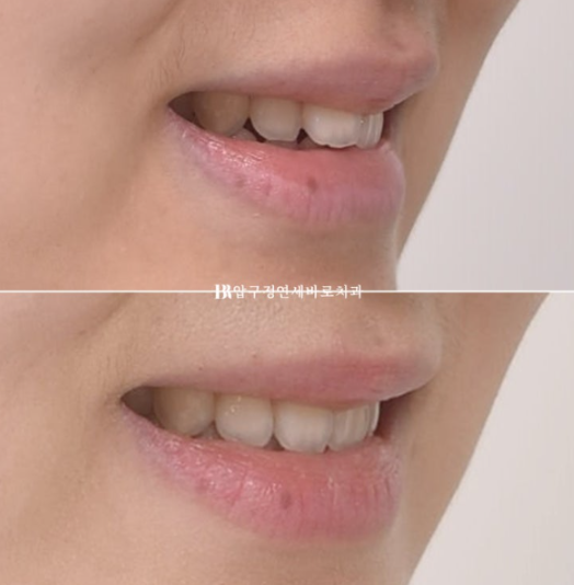 인비절라인 익스프레스 토끼이빨 교정 기간? 인비절라인 종류는? 관련 이미지 15