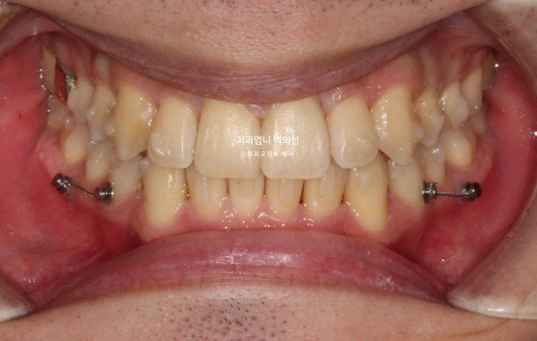 인비절라인 비발치 앞니 돌출 교정 치료기간 2년 5개월 관련 이미지 7