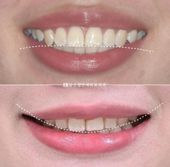 A Review of Extraction Orthodontic Treatment for Protruding Mouth | The Details of Orthodontics That Transform Buccal Corridors and Smile Lines image 13