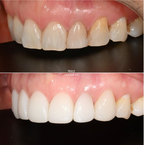 40대 무삭제 라미네이트 블랙트라이앵글 레진 치료 관련 이미지 9