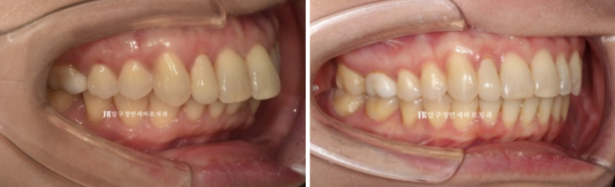 Invisalign Lite for Orthodontic Treatment in Your 40s: Crossbite and Protrusive Mouth Correction image 13