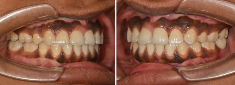 Extraction & re-orthodontics with Clippy-C, intrusion for dental implant. 관련 이미지 16