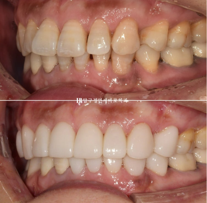 50대 라미네이트 삭제 없이 하는 법? 관련 이미지 11