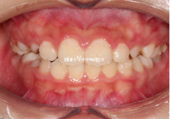 강남 소아교정 인비절라인 퍼스트 어린이 반대교합 관련 이미지 6
