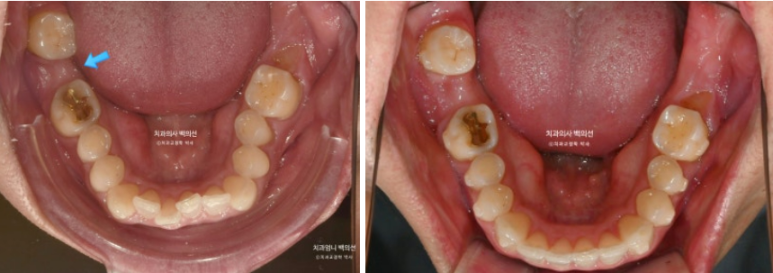40대 인비절라인 라이트 과개교합 과잉치 덧니 교정 임플란트 보철 교정 후기 관련 이미지 15