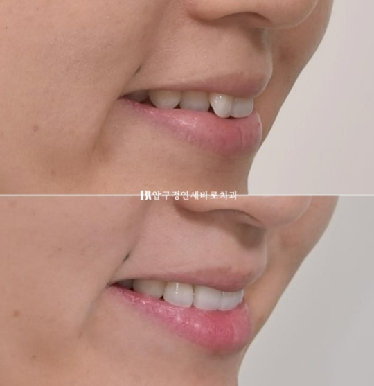 Gangnam Orthodontic Clinic: A Woman in Her 30s’ Rabbit Teeth Correction Review|Six-Month Front Teeth Partial Orthodontic Treatment That Also Improved a Crossbite image 12