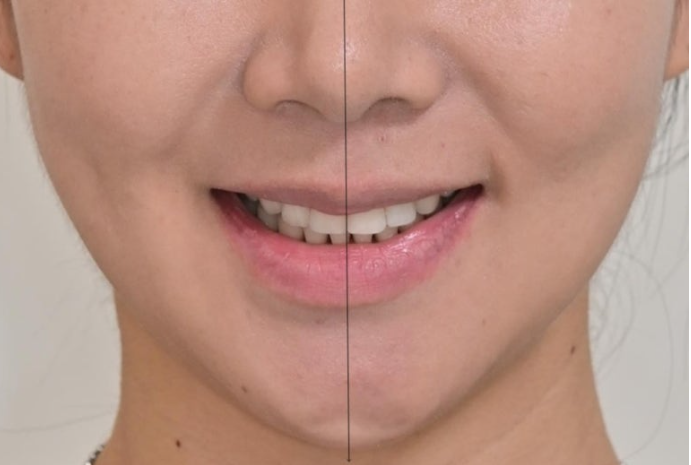 옥니 역교정 재교정 무턱 교정 치료기간 1년 10개월 관련 이미지 13