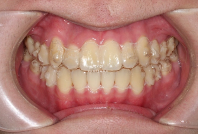 유학생 교정 덧니 반대교합 인비절라인 라이트 치료기간 관련 이미지 6