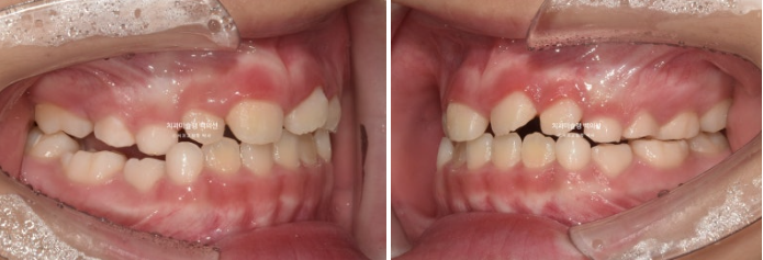 어린이 비대칭 반대교합 주걱턱 인비절라인 퍼스트 프리올소 성장 교정 관련 이미지 9