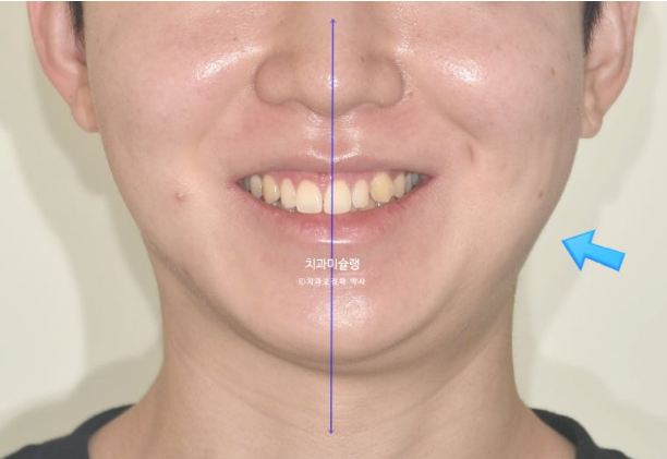 비대칭 비발치 거미스마일 잇몸미소 중심선 가위교합치료 무삭제 라미네이트 관련 이미지 3