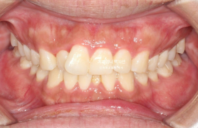 앞니 부분교정 덧니 교정 블랙트라이앵글 부정교합 마모 시뮬레이션 치료기간 5개월 관련 이미지 2