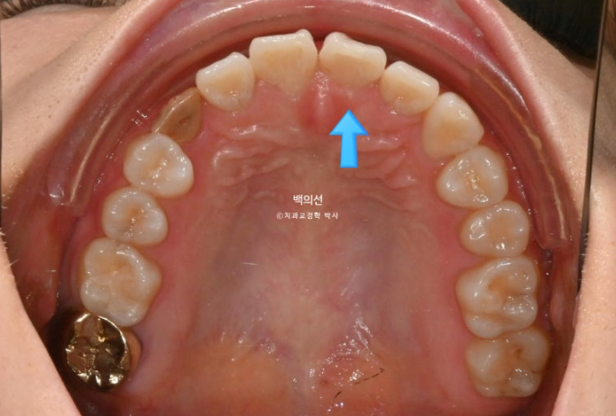 매복 결손 잔존유치 라미네이트 크라운 캔팅 인비절라인 라이트 치료 관련 이미지 5