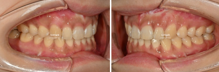 선수술 양악수술 비대칭 주걱턱 잇몸미소 치료 인비절라인 라이트 관련 이미지 14