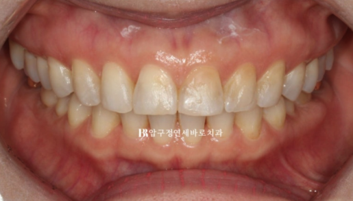 Laminate Veneers in Your 50s: Is It Possible Without Shaving Down the Teeth? | No-Prep Laminate Veneers + Real Case of Front Tooth Partial Orthodontics image 4