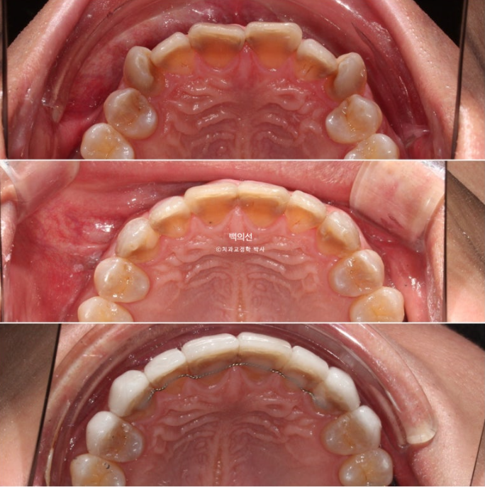 Treatment Review: No-Prep Laminate for Tetracycline-Stained Teeth image 18