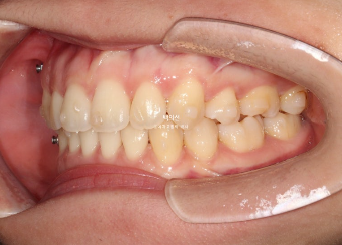 돌출입 교정 인비절라인 발치 교정 개방교합 치료 후기 관련 이미지 15