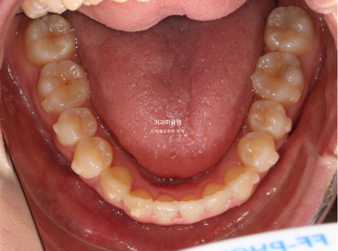 인비절라인 비발치 토끼이빨 교정 덧니 교정 치료기간 1년 8개월 관련 이미지 9
