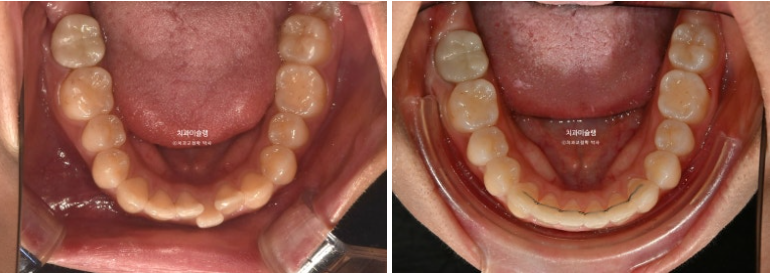 유학생 치아교정 해외거주 한국에서 치아교정? 관련 이미지 16