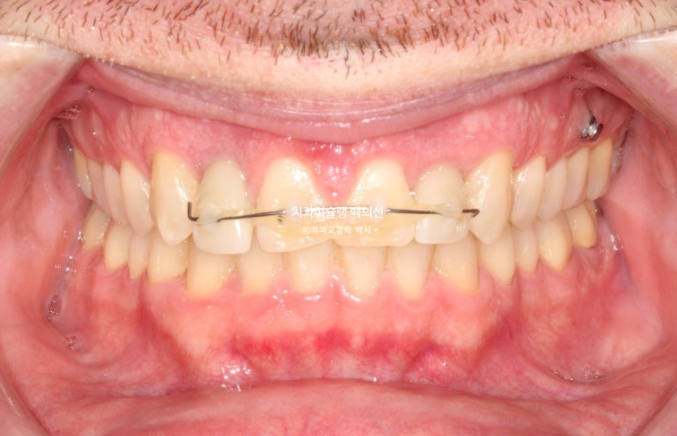 앞니 선천적 결손 인비절라인 임플란트 과개교합 치료 기간 관련 이미지 20