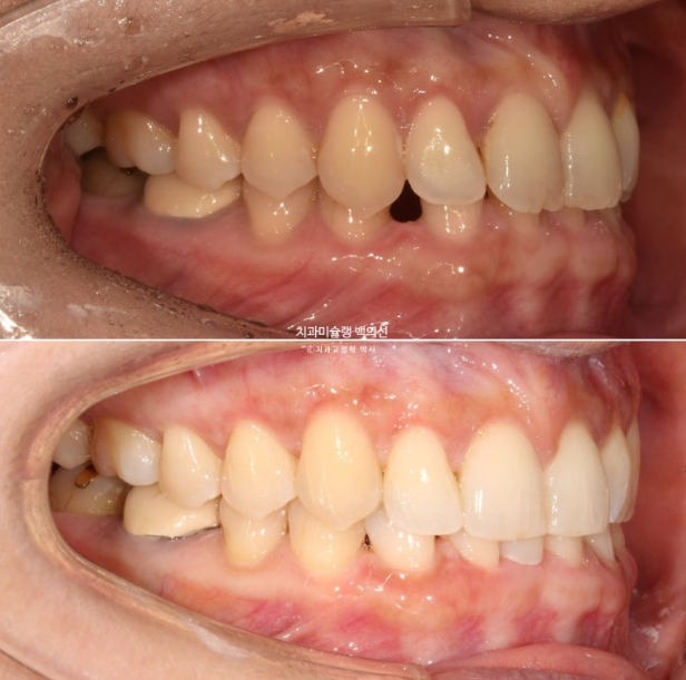 해외거주 앞니 선천적 결손 과개교합 인비절라인 라이트 브릿지 치료 관련 이미지 18