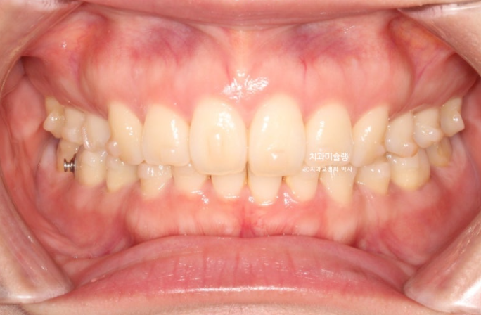 돌출입 덧니 발치 교정 인비절라인 교정 후기 관련 이미지 16