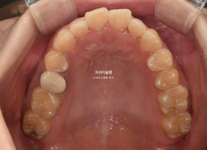 비발치 인비절라인 교정 편측 개방교합 가위교합 돌출 재교정 관련 이미지 5