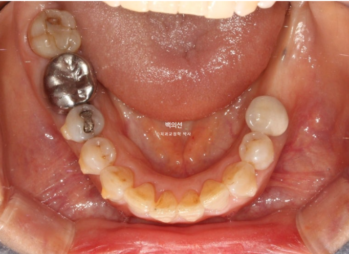 40대 인비절라인 라이트 앞니 돌출 과개교합 덧니 교정 후기 관련 이미지 11