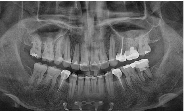 돌출입 발치 교정 인비절라인 후기 미니스크류 관련 이미지 25