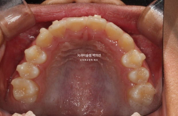 덧니 반대교합 과개교합 인비절라인 퍼스트 악궁확장 어린이 교정 관련 이미지 7