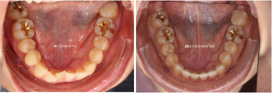 토끼이빨 치아교정 ? 토끼이빨 교정 치료기간은 어떻게 되나요? 관련 이미지 7