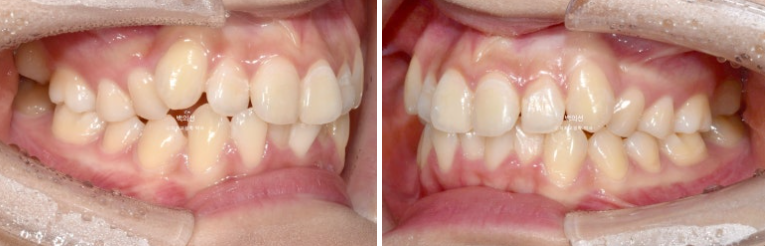 비발치 덧니교정 인비절라인 교정 사랑니 이용 교정 관련 이미지 4