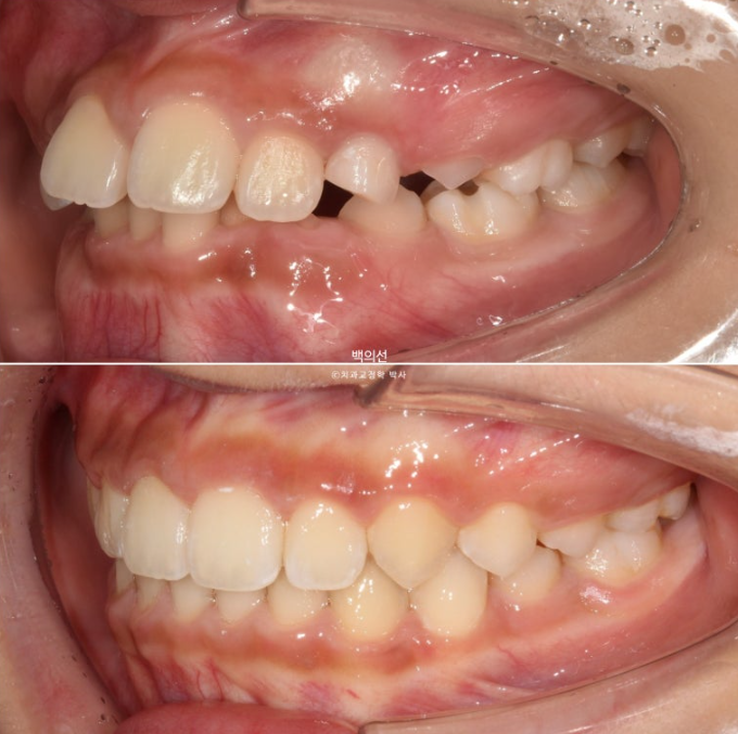 인비절라인퍼스트 어린이 투명교정 과개교합 덧니 악궁확장 돌출 관련 이미지 21