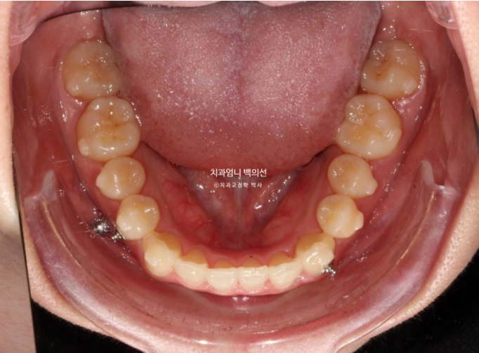 인비절라인 교정 비발치 비대칭 덧니 중심선 선천적 결손치 교정? 관련 이미지 12