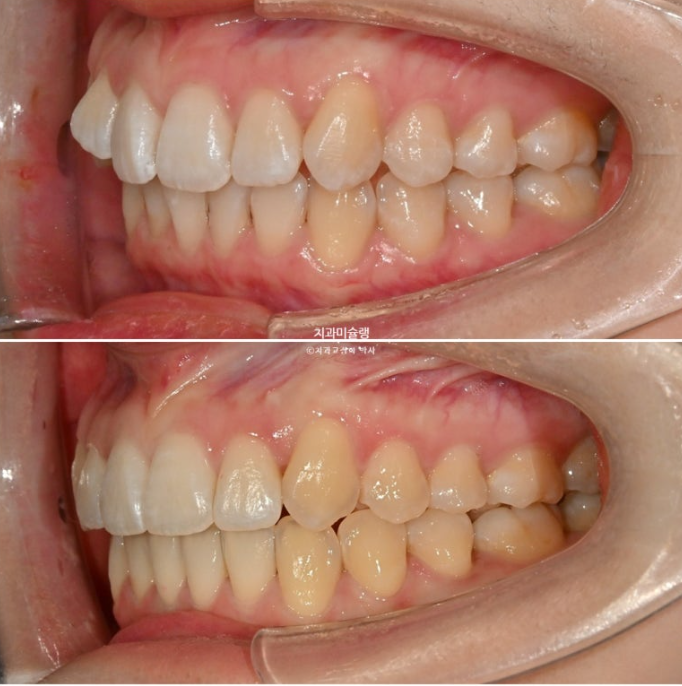 덧니 인비절라인 라이트 잇몸미소 거미스마일 중심선 블랙트라이앵글 관련 이미지 18