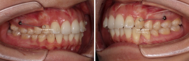 비발치 인비절라인 교정 돌출입 교정 후기 관련 이미지 5