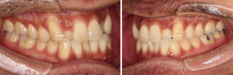 30대 MSE 악궁확장 덧니 반대교합 비발치 클리피씨 부작용 관련 이미지 2
