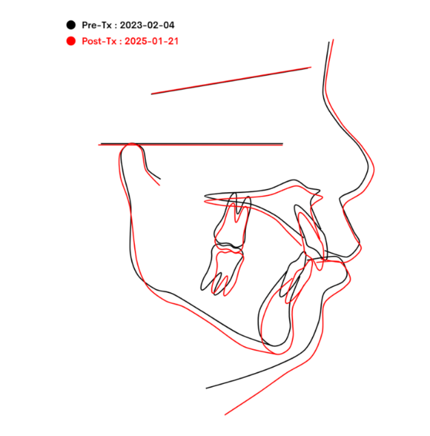 Invisalign First Correction for a Retruded Chin in a Child Orthodontic Treatment for Protrusion image 25